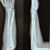 Isolated Ulnar Shortening Osteotomy for a Distal Radius Malunion in a Young Female: A Cosmetic and Functional Success Story