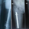 Functional Outcome of Retrograde Femoral Nailing Versus Minimally Invasive Percutaneous Plate Osteosynthesis in Extra-Articular Distal Femur Fractures: A Prospective Quasi-Randomized Comparative Study