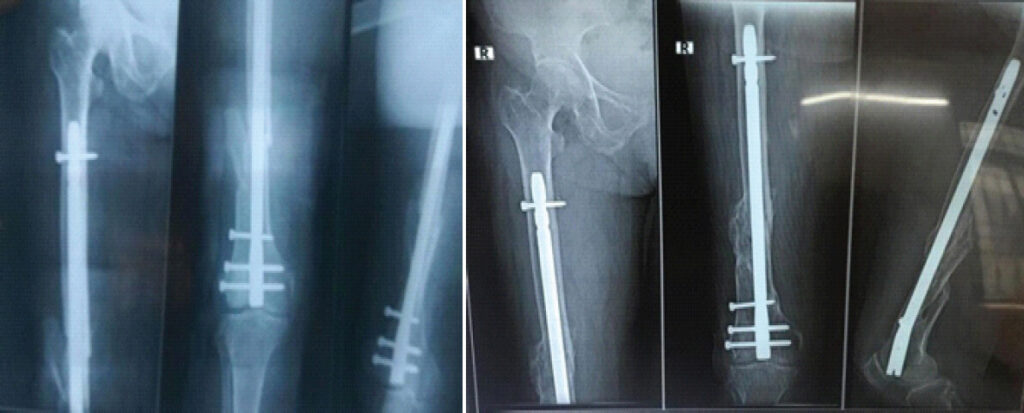 Figure 1: Representative post-operative radiographs showing retrograde femur nailing and 6-month follow-up radiograph.