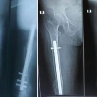Figure 1: Representative post-operative radiographs showing retrograde femur nailing and 6-month follow-up radiograph.
