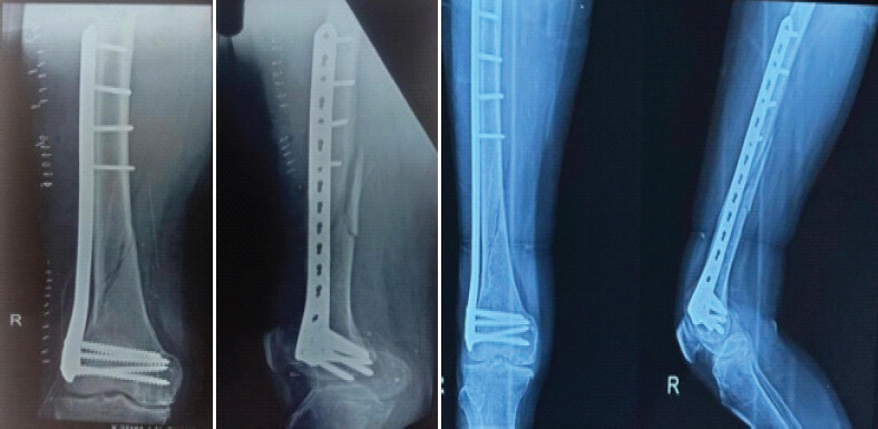 Figure 2: Representative post-operative radiographs showing minimally invasive percutaneous plate osteosynthesis and 6-month follow-up radiograph.