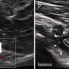 Improved range of motion in three cases following axillary nerve hydrorelease after reverse shoulder arthroplasty: a case series