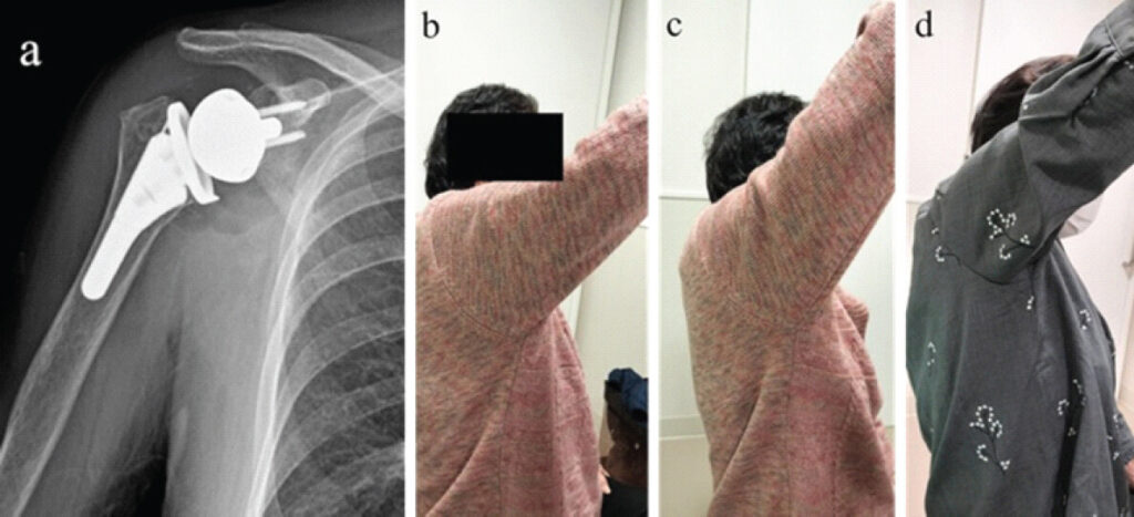 Figure 2: Imaging of Case 1 (a) Postoperative anteroposterior X-ray. (b) At 3 months postoperative, prior to axillary nerve HR. (c) At 3 months postoperative, immediately after axillary nerve HR. (d) At 1 year postoperative.