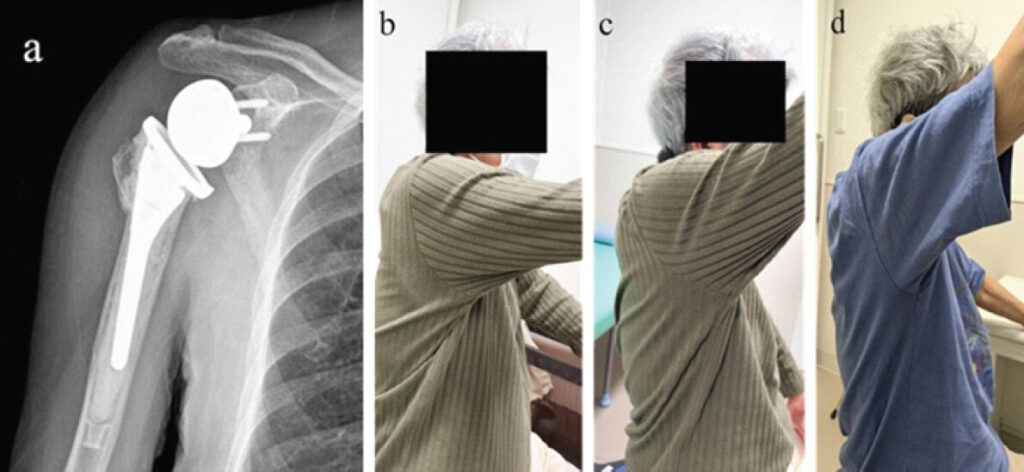 Figure 3: Imaging of Case 2 (a) Postoperative anteroposterior X-ray. (b) At 3 months postoperative, prior to axillary nerve HR. (c) At 3 months postoperative, immediately after axillary nerve HR. (d) At 1 year postoperative.