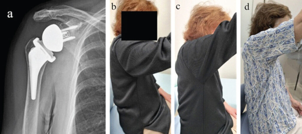Figure 4: Imaging of Case 3 (a) Postoperative anteroposterior X-ray. (b) At 3 months postoperative, prior to axillary nerve HR. (c) At 3 months postoperative, immediately after axillary nerve HR. (d) At 1 year postoperative.