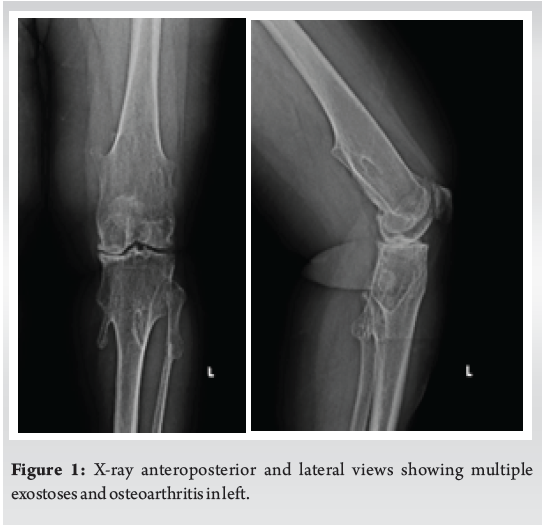 Total Knee Replacement for Varus Deformity in Osteoarthritis of Knee ...