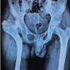 Role of Ortho Biologics in Subtrochanteric Osteotomy Non-union in a Case of Developmental Hip Dysplasia Managed with Total Hip Replacement – A Case Report