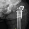 Unexplained Pseudotumor Formation in Ceramic-on-ceramic Hip Bearings: A Case Report