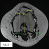 Lax Medial Patellofemoral Ligament Syndrome as a Cause of Recurrent Patellar Instability: A Radiologic Case Series