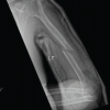 Humerus Shaft Fracture in Adult Managed with Elastic Nails: A Case Report and Literature Review of Management Options