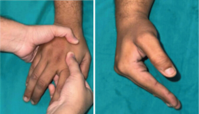 Figure 1: (a) Initial reduction, (b) Positioning of joints.