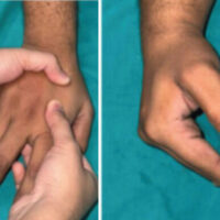 Figure 1: (a) Initial reduction, (b) Positioning of joints.