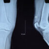 Arthroscopic Posterior Cruciate Ligament Tibial Spine Avulsion Fixation Using a Suture Pull-Through Single-Tunnel Technique