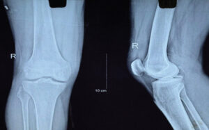 Figure 1: Pre-operative radiographs showing the posterior cruciate ligament tibial avulsion fracture. Patient identifiers have been removed.
