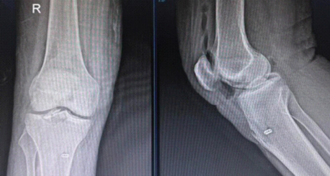Figure 2: Post-operative radiographs demonstrating reduction and the single-tunnel cortical fixation construct.