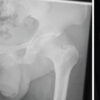 Pertrochanteric Femur Fracture in a Post-Polio Patient treated with a Pediatric Hip Plate: A Case Report