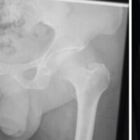 Figure 1: Anteroposterior and axial radiographs preoperatively demonstrating the fracture and the abnormal anatomy of the affected limb.