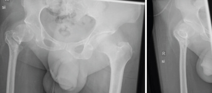Figure 1: Anteroposterior and axial radiographs preoperatively demonstrating the fracture and the abnormal anatomy of the affected limb.