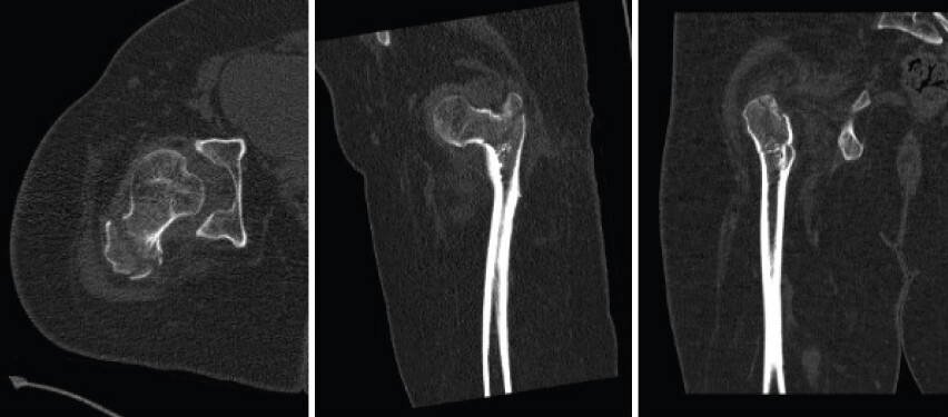 Figure 2: Computed tomography scan in anteroposterior, sagittal and axial views demonstrating the anatomical details of the affected limb.
