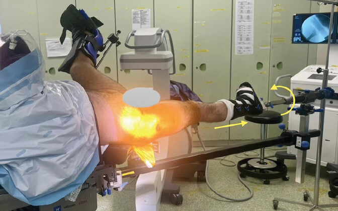 Figure 3: Intraoperative positioning on the operating table in extension, demonstrating the internal rotation required (35°) to achieve anatomical reduction, along with the corresponding fluoroscopic result displayed on the monitor.