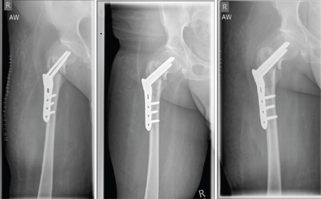Figure 4: Immediate postoperative anteroposterior and axial radiographs demonstrating anatomical reduction and correct position of the pediatric locking compression plate hip plate.