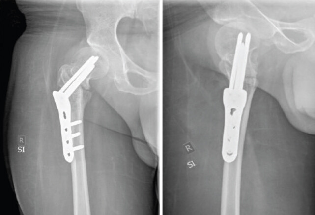 Figure 5: Six-week follow-up radiographs demonstrating a persistent visible fracture line with unchanged positioning of the surgical hardware and no signs of secondary fracture-dislocation.