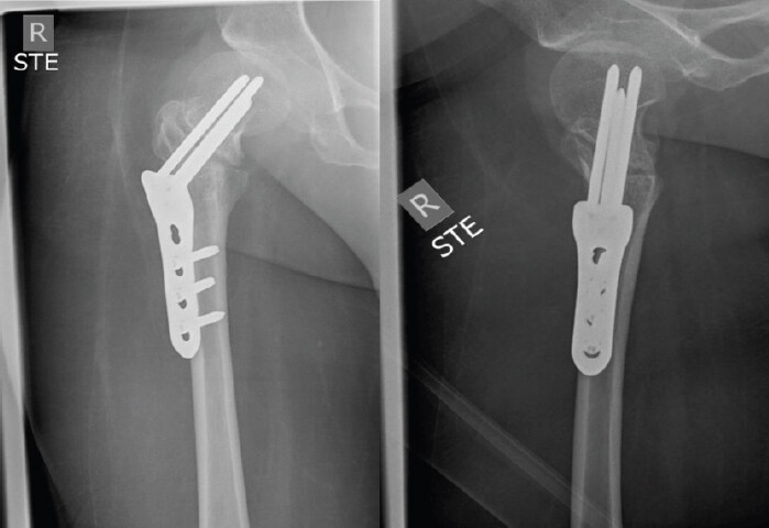 Figure 6: Twelve-week follow-up anteroposterior and axial radiographs demonstrating a persistent fracture line, but progressive bony healing with no evidence of implant loosening or loss of reduction.