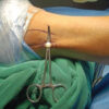 From Ankle to Knee: Donor-Site Morbidity after Peroneus Longus Tendon Graft for ACL Reconstruction Assessed by the Kitaoka Ankle-Hindfoot Score – A Prospective Cohort Study