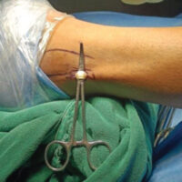Figure 1: 1.5 cm longitudinal incision.