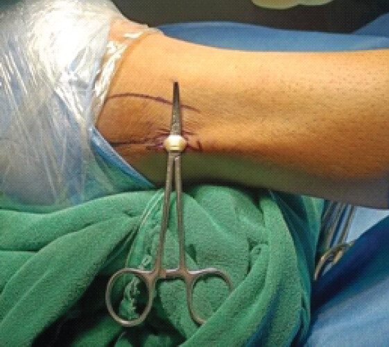 Figure 1: 1.5 cm longitudinal incision.