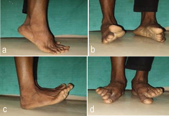 Figure 3: Movements at 6 months follow-up. (a) Plantarflexion, (b) inversion, (c) dorsiflexion, and (d) eversion.