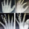 A Functional Outcome of Closed Intra-articular Fracture of Proximal Interphalangeal Joint of Hand Managed By Suzuki Frame – A Longitudinal Study