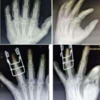 Figure 1: Pre-operative and immediate post-operative hand anteroposterior and oblique X-rays.