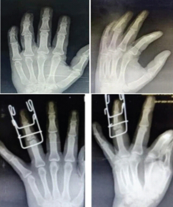 Figure 1: Pre-operative and immediate post-operative hand anteroposterior and oblique X-rays.