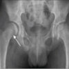 Clinical Presentation, Orthopedic Outcomes, and Microbiological Spectrum in Pediatric Septic Arthritis: A Prospective Study