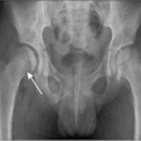Figure 1: Pre-operative radiograph (anteroposterior pelvis) of a 7-year-old boy with right hip septic arthritis showing widening of the hip joint space and hazy articular contours (arrow).