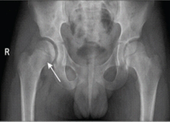 Figure 1: Pre-operative radiograph (anteroposterior pelvis) of a 7-year-old boy with right hip septic arthritis showing widening of the hip joint space and hazy articular contours (arrow).