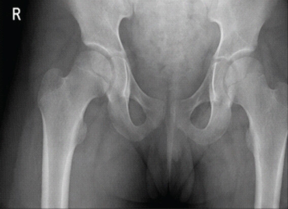 Figure 2: Immediate post-operative radiograph (anteroposterior pelvis) after surgical drainage showing restoration of joint space and improved alignment.
