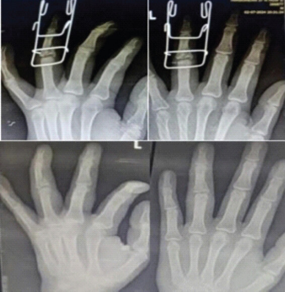 Figure 2: 6th week post-operative and 9th week follow-up X-rays.