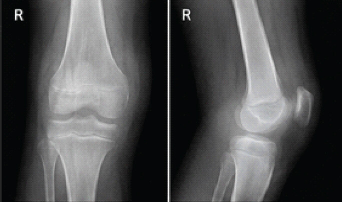 Figure 3: Pre-operative radiographs of right knee (anteroposterior and lateral views) in a 10-year-old boy showing joint effusion with soft-tissue swelling and preserved bone contours.