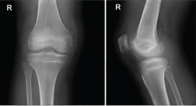 Figure 4: Post-operative radiographs (anteroposterior and lateral views) after arthroscopic washout showing reduced joint effusion and maintained joint space without bony destruction.
