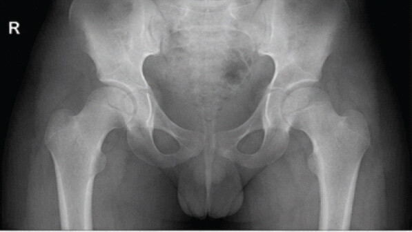 Figure 5: Follow-up radiograph (anteroposterior pelvis) at 6 months in the same patient showing good remodeling of the right hip with preserved joint space and normal contours.