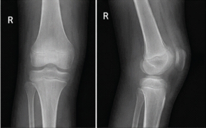 Figure 6: Follow-up radiographs (anteroposterior and lateral views) of the right knee at 6 months showing normal alignment, no joint space narrowing, and preserved epiphyseal growth plate.