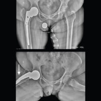 Figure 1: Pre-operative radiographs showing a fracture of the long stem prosthesis distal to the lesser trochanter in the metaphyseal-diaphyseal region. In the frog-leg lateral view, a partial breach of the lateral cortex is observed (white arrow).