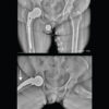 Extraction of a Fractured, Well-Fixed Femoral Stem Using a Lateral Cortical Window Technique in Revision Hip Arthroplasty: A Case Report
