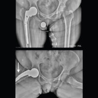 Figure 1: Pre-operative radiographs showing a fracture of the long stem prosthesis distal to the lesser trochanter in the metaphyseal-diaphyseal region. In the frog-leg lateral view, a partial breach of the lateral cortex is observed (white arrow).