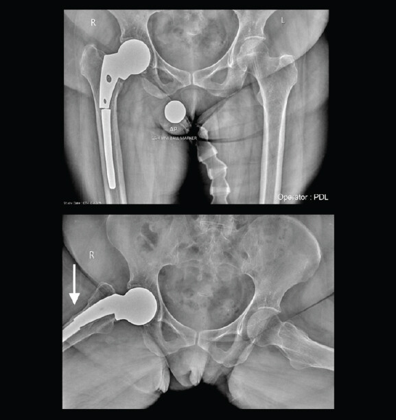 Figure 1: Pre-operative radiographs showing a fracture of the long stem prosthesis distal to the lesser trochanter in the metaphyseal-diaphyseal region. In the frog-leg lateral view, a partial breach of the lateral cortex is observed (white arrow).
