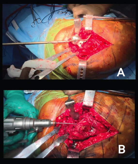 Figure 2: Intraoperative images demonstrating the universal stem extraction system using a bone hook, slap hammer, and a closed stem extractor to remove the proximal fractured prosthesis (a). In the fourth image, an intramedullary trephine technique is undertaken with K-wires to loosen the distal stem prosthesis (b).