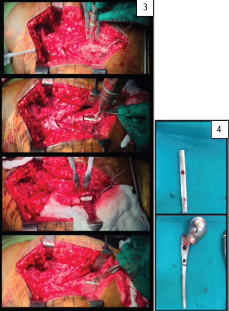 Figure 3: Intraoperative images showing a 4 × 2 cm lateral cortical window created using a high-speed burr and a crater made over the surface of the stem to allow stable engagement of an osteotome at an angle of 45° and undergo retrograde impaction for extraction. Figure 4: Images of the fractured prosthesis removed.