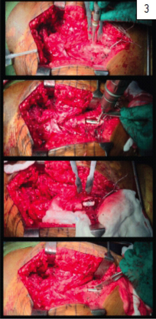 Figure 3: Intraoperative images showing a 4 × 2 cm lateral cortical window created using a high-speed burr and a crater made over the surface of the stem to allow stable engagement of an osteotome at an angle of 45° and undergo retrograde impaction for extraction.